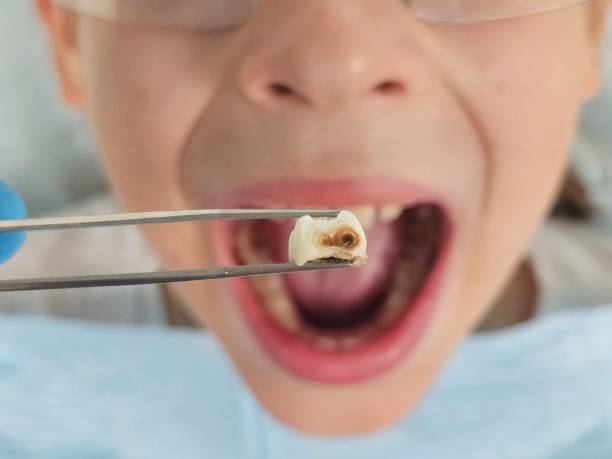 Best Urgent Tooth Repair  in Eureka Mill, SC
